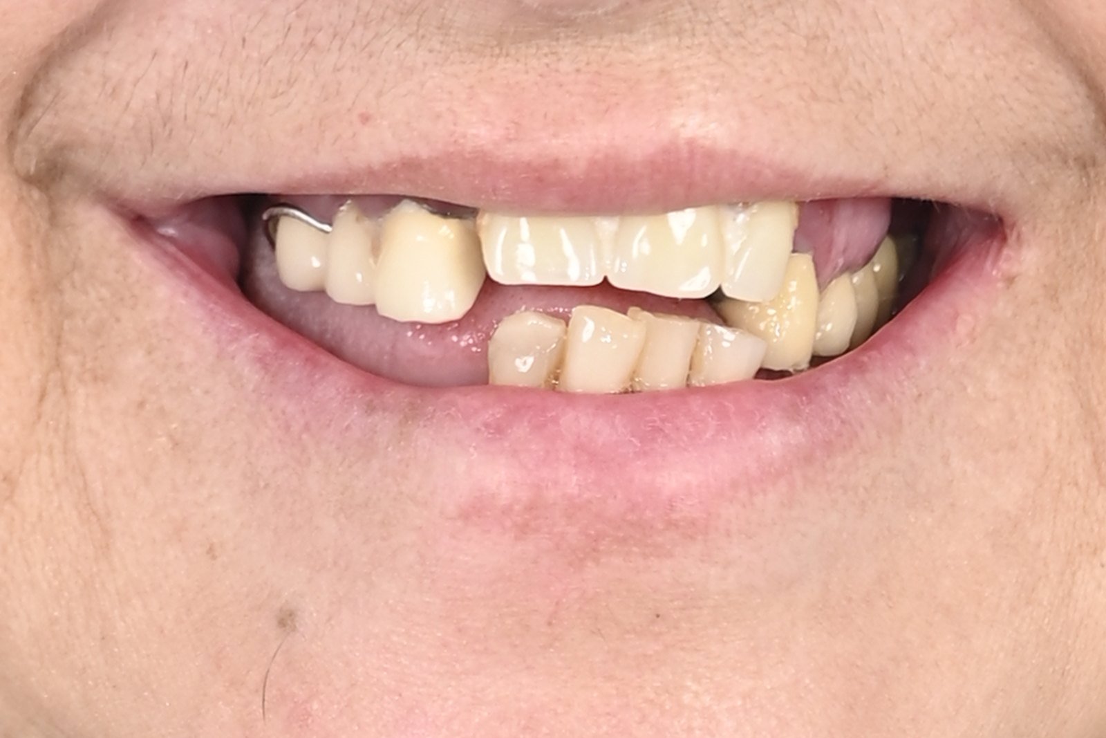 Antes: Dientes fijos en 24 horas con implantes cigomáticos