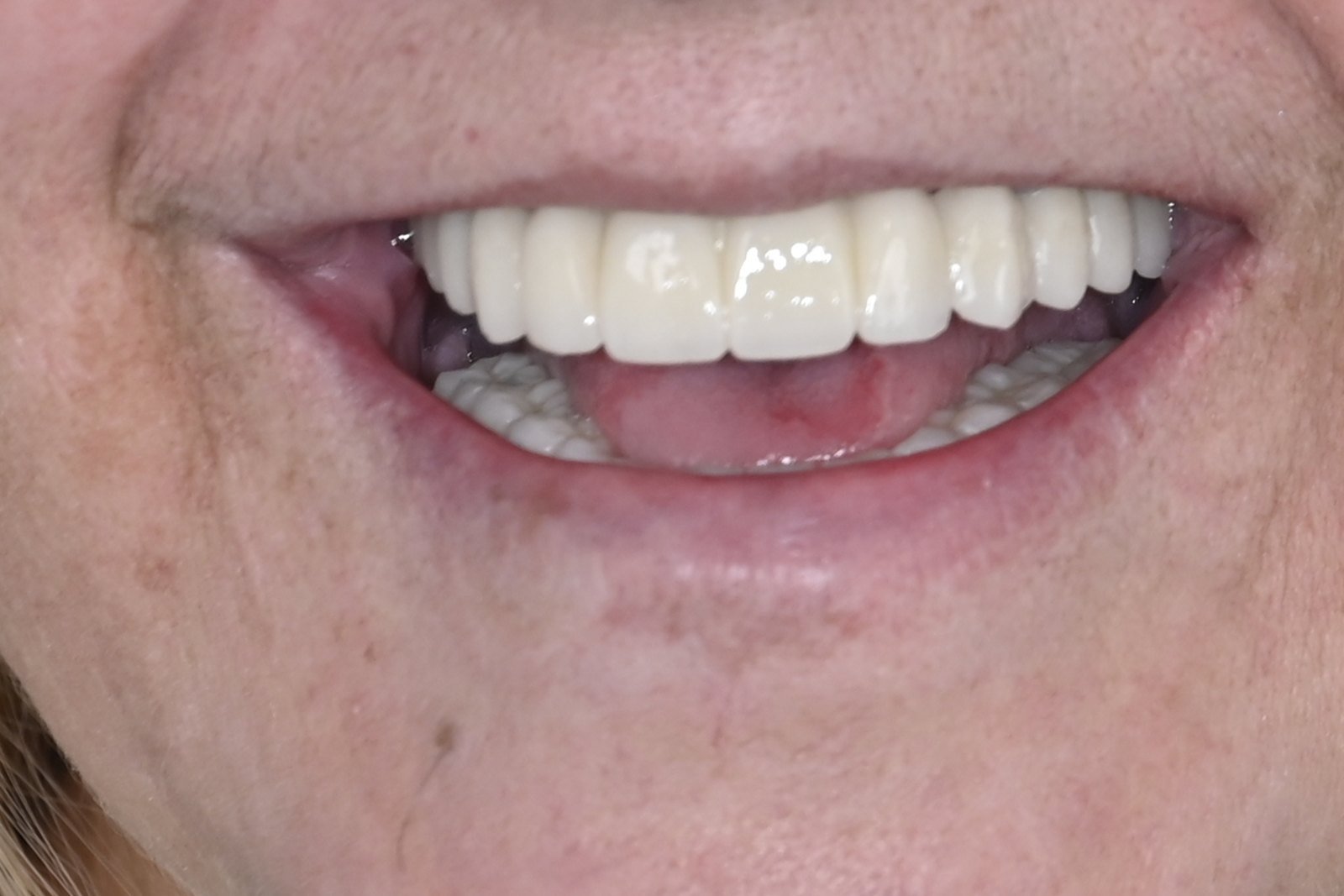 Después: Dientes fijos en 24 horas con implantes cigomáticos
