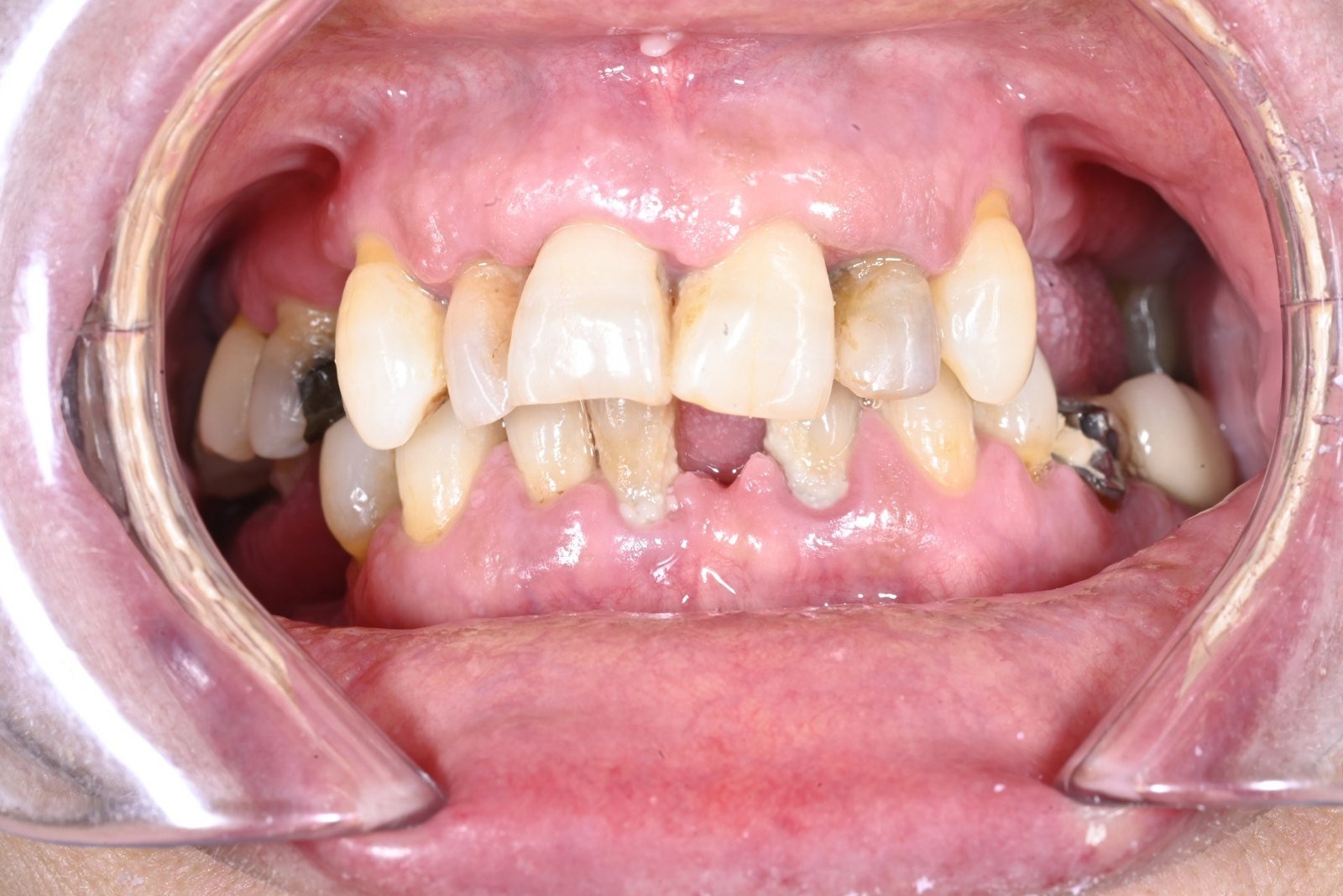 Antes: Rehabilitación completa sobre 12 implantes con carga inmediata