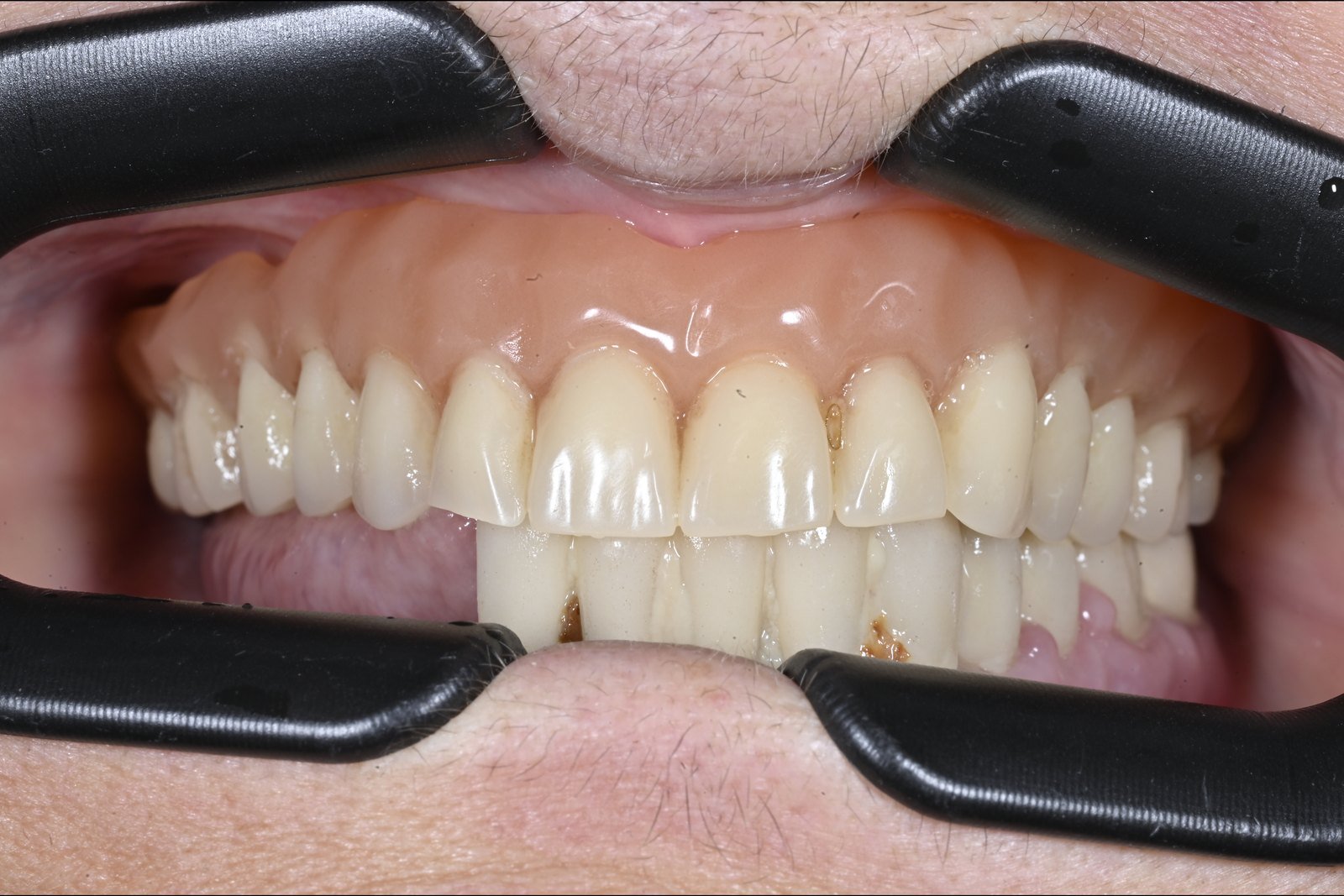 Antes: Rehabilitación completa con implantes cigomáticos y prótesis híbridas