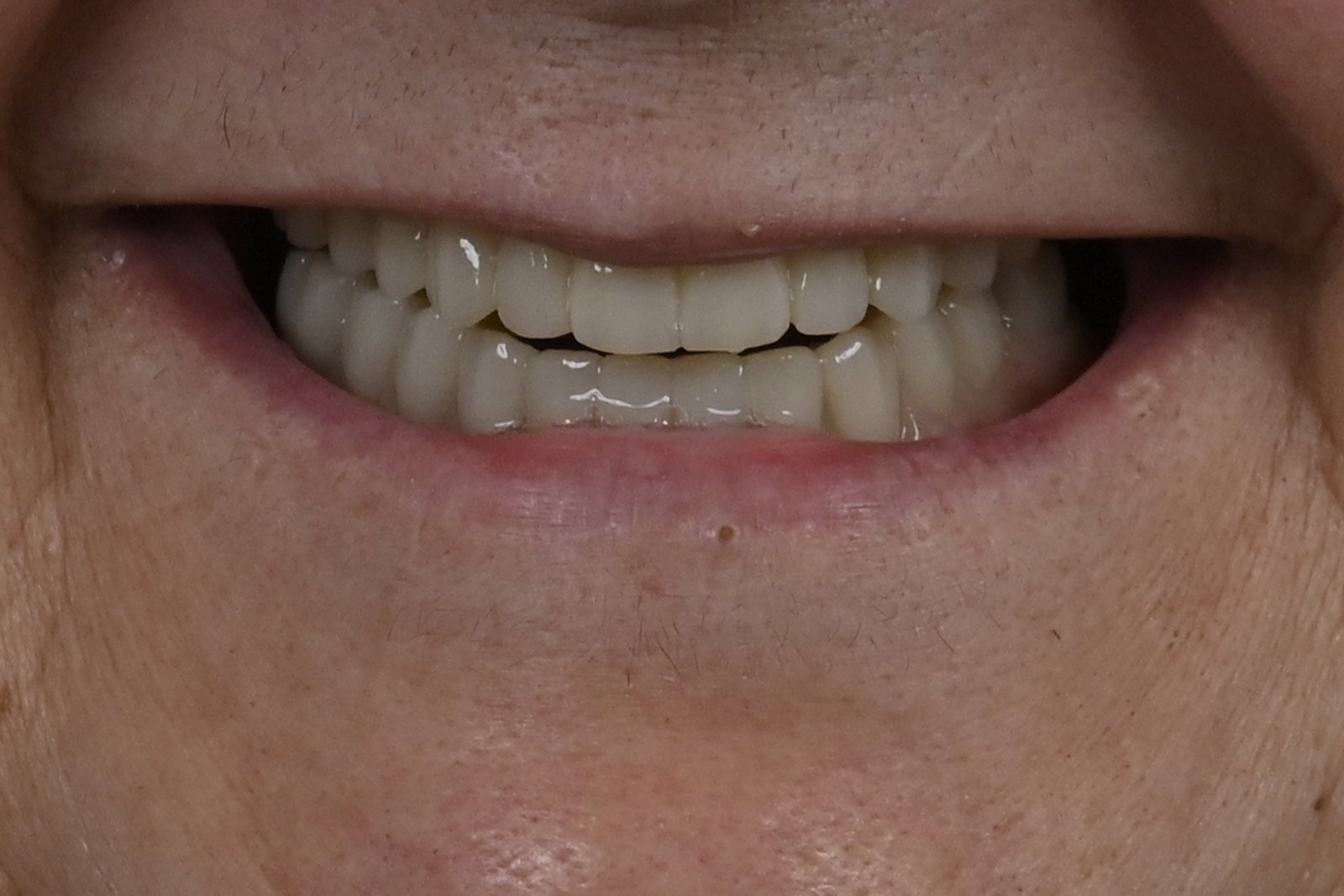 Después: Rehabilitación completa con implantes cigomáticos y prótesis híbridas