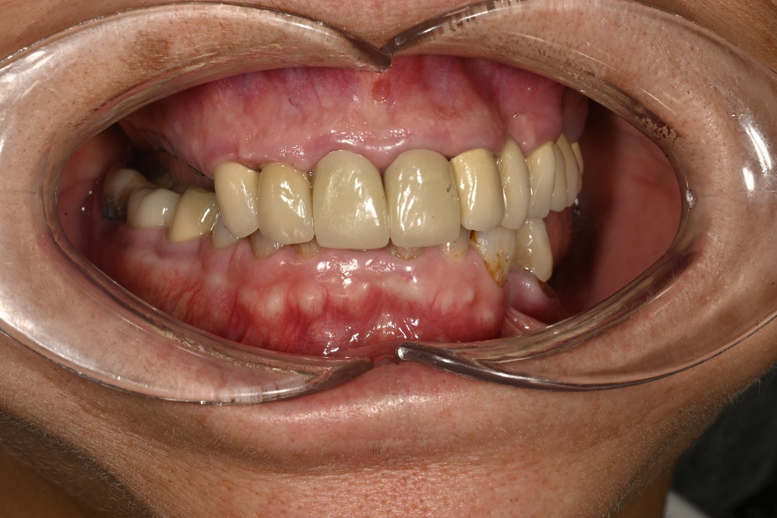 Antes: Dos sobredentaduras sobre 9 implantes