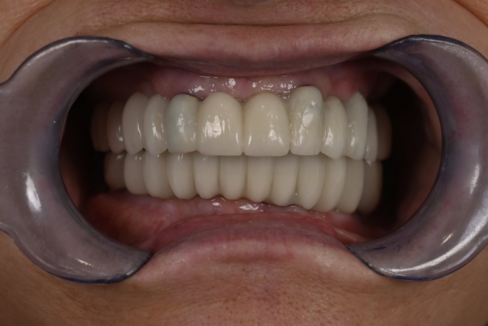 Después: Dos sobredentaduras sobre 9 implantes