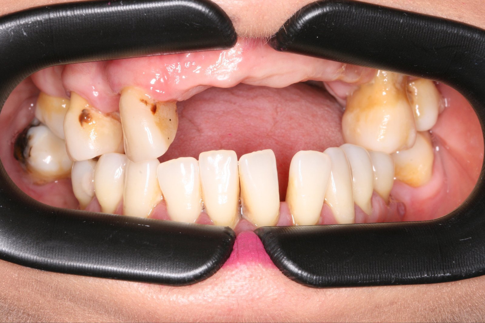 Antes: Rehabilitación completa con implantes cigomáticos