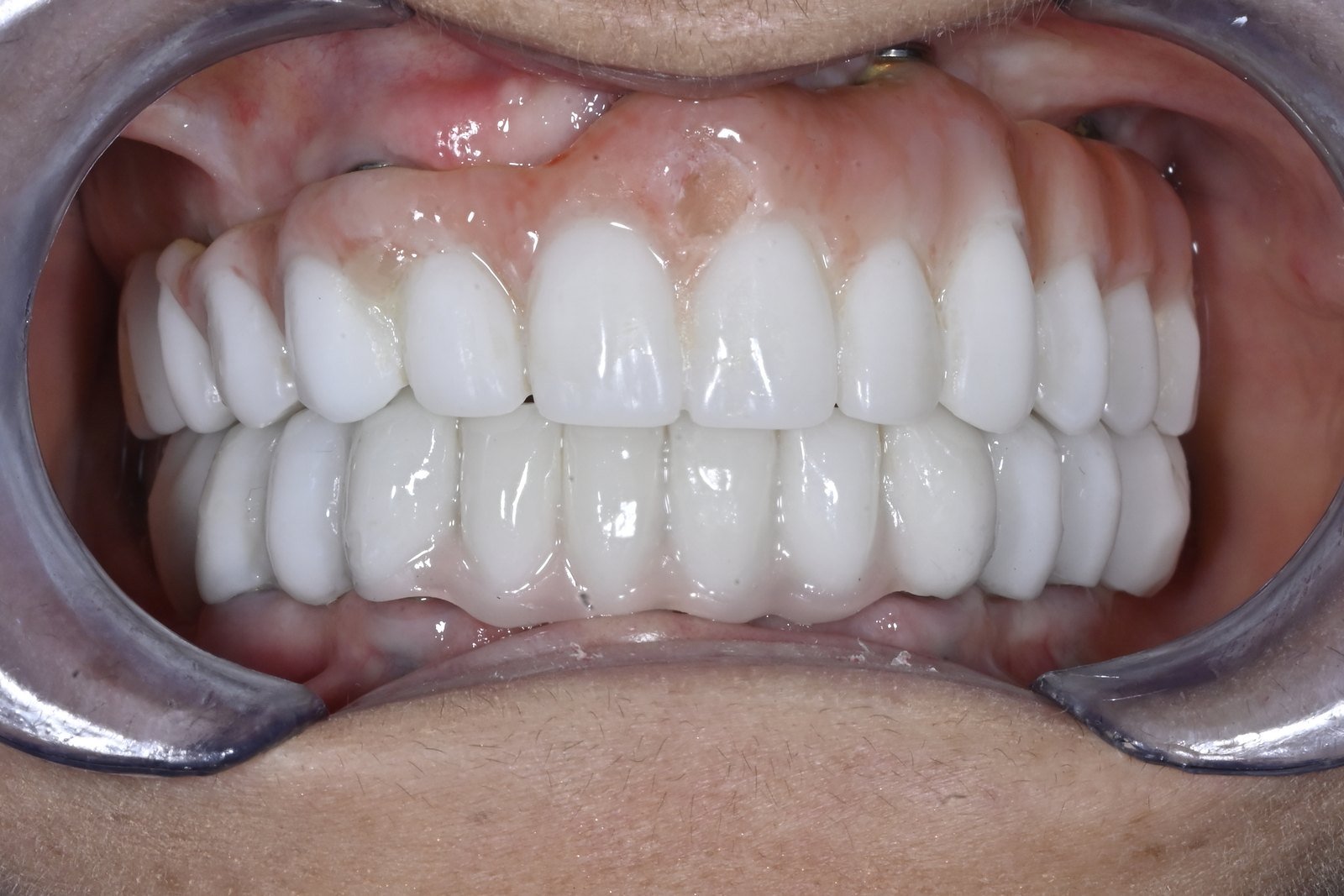 Después: Rehabilitación completa con implantes cigomáticos