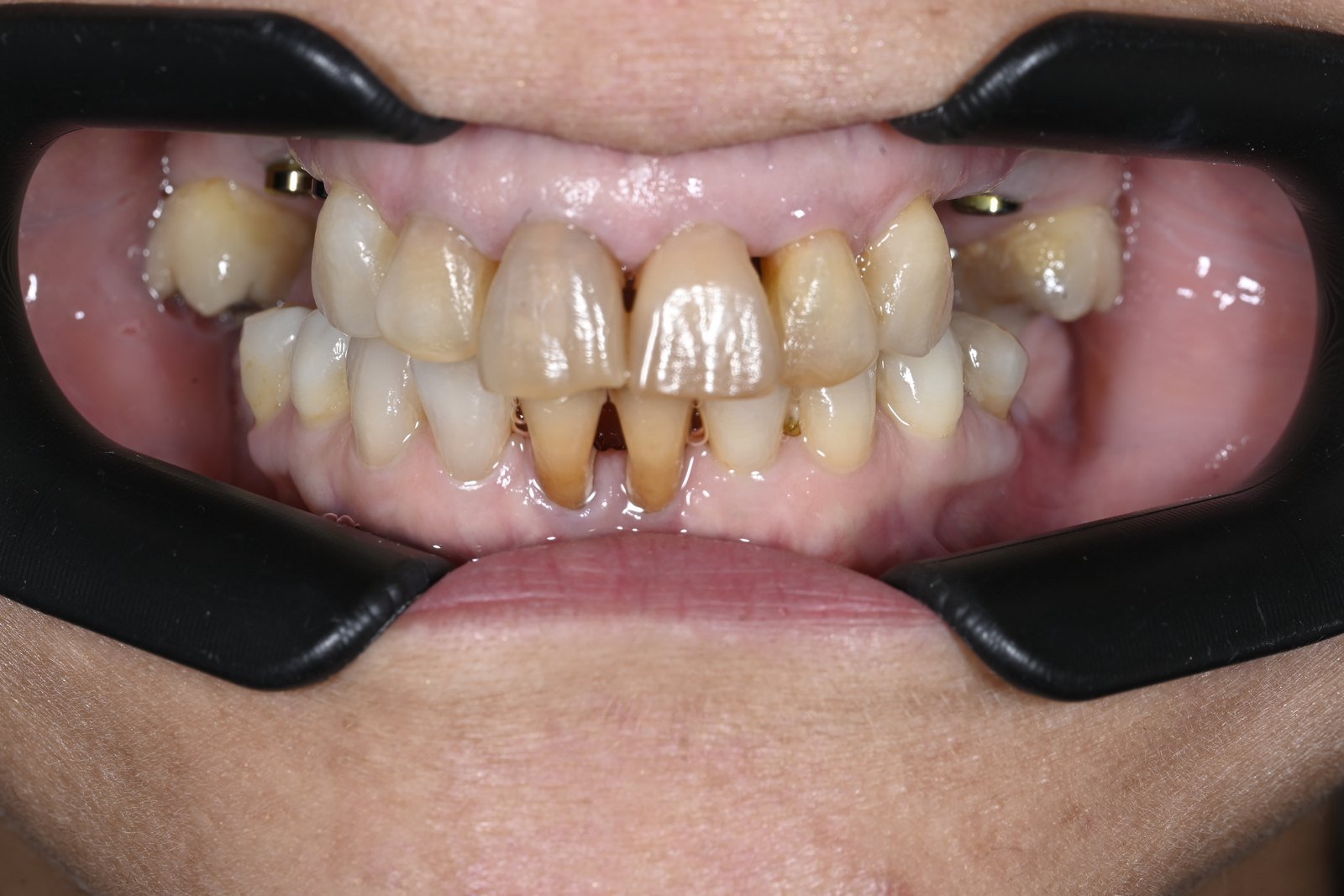 Antes: Blanqueamiento interno de dientes oscurecidos