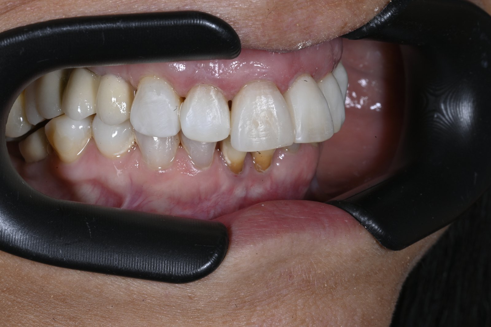 Después: Blanqueamiento interno de dientes oscurecidos